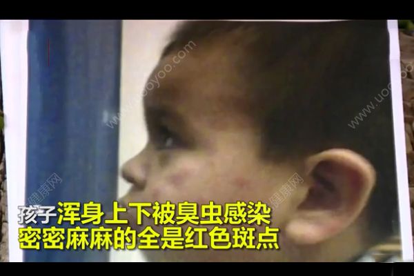 幼兒遭臭蟲咬傷獲賠1000萬！遭到蟲子咬怎么急救？(4)