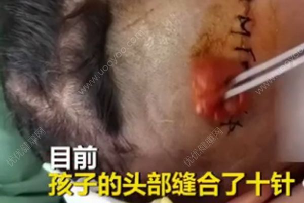 3歲男孩小區(qū)內(nèi)被狗咬頭縫10針，被狗咬傷后怎么處理？(4)