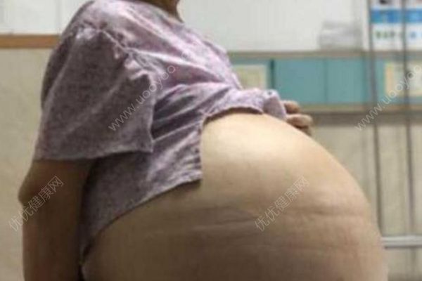 69歲大媽患婦科腫瘤肚鼓如球，醫(yī)生抽出30多升囊液(1)