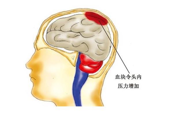 腦溢血患者家屬質(zhì)疑被過期藥加重病情，醫(yī)院:只用了一瓶(4)