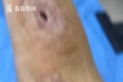 男子殺魚時不小心劃傷手指，幾個月后右手手臂被"蛀空"[多圖]