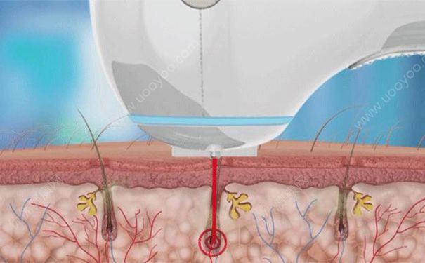激光脫毛有副作用么？激光脫毛有什么副作用？(2)