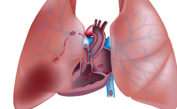 肺栓塞的癥狀有哪些？肺栓塞的臨床表現(xiàn)是什么？(1)