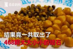 愛吃油炸長468顆結石，油炸食品的危害有哪些？[多圖]