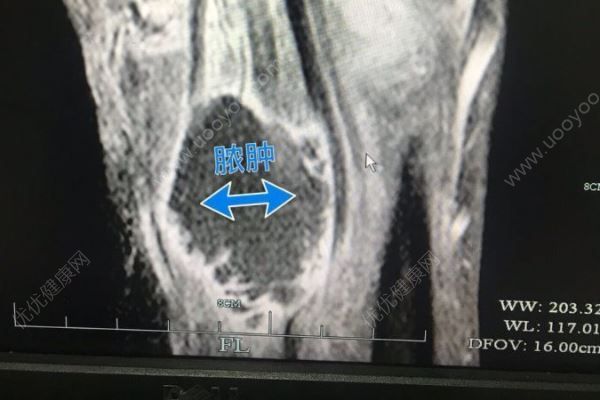 男子被蝦刺中手臂爛得差點截肢，被蝦刺到怎么辦(1)