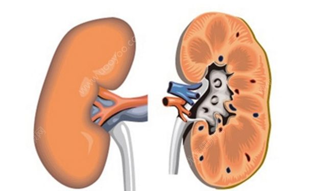 腎囊腫是怎么回事？腎囊腫治療方法(1)