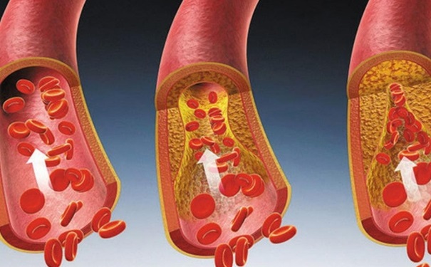 哪些食物能有效的清除血管垃圾？血管出現(xiàn)問題的癥狀有哪些？(1)