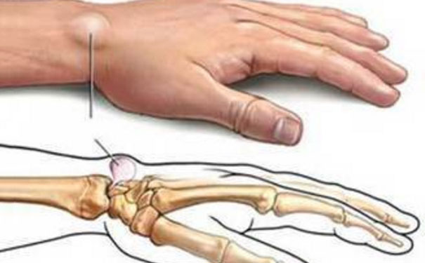 手腕起了一個鼓包怎么回事？手腕鼓包是什么原因？(1)