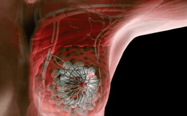 乳腺癌的早期信號(hào)是什么？誘發(fā)乳腺疾病的原因是什么？(1)