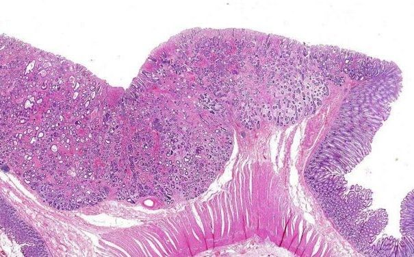 直腸癌有哪些病因？直腸癌有何治療方法？(3)