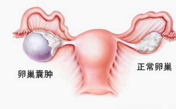 卵巢腫瘤嚴(yán)重嗎？卵巢腫瘤手術(shù)(1)