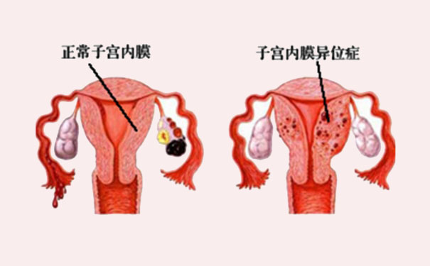 子宮內(nèi)膜異位癥能自然懷孕嗎？子宮內(nèi)膜異位癥為什么影響懷孕？(1)