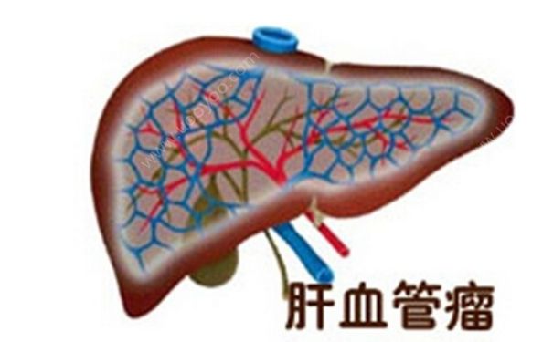 肝血管瘤嚴(yán)重嗎？肝血管瘤的癥狀表現(xiàn)(1)