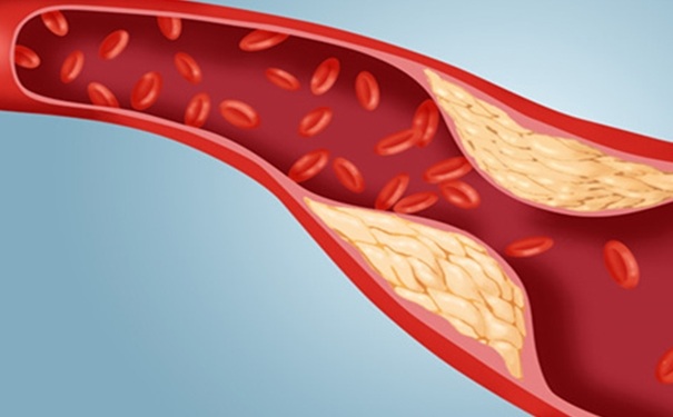 動脈粥樣硬化有哪些危害？動脈粥樣硬化怎么調(diào)理？(1)