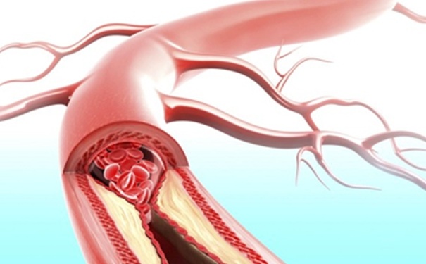 動(dòng)脈硬化和動(dòng)脈粥樣硬化 動(dòng)脈硬化和動(dòng)脈粥樣硬化有什么區(qū)別？(1)