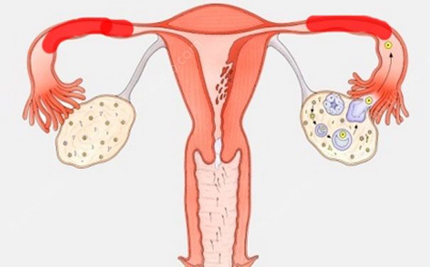 輸卵管堵塞還能排卵嗎？輸卵管堵塞怎么辦？(2)