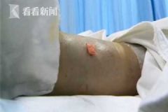 女子清晨上廁所踩到毒蛇被咬，整條腿變"大象腿"[多圖]