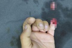 6歲男孩被夾斷手指，罪魁禍?zhǔn)拙故切７?，手指斷了如何急救？[多圖]