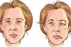 面癱是什么原因?qū)е碌?？面癱是因為風(fēng)吹的嗎？[圖]
