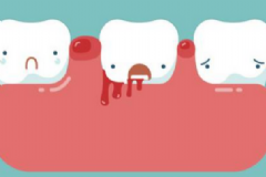 刷牙出血怎么辦好？刷牙出血怎么快速緩解？[圖]