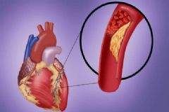 動(dòng)脈硬化有何癥狀？動(dòng)脈硬化如何診斷？[圖]