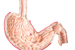 哪些習(xí)慣容易患胃癌？哪些人容易患胃癌？[圖]