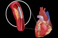 心臟病人要如何護(hù)理？心臟病有哪些危害？[圖]