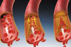 如何清除血管內(nèi)垃圾？血管有垃圾有何危害？[圖]