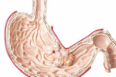 胃癌早期的癥狀有哪些？如何及時(shí)發(fā)現(xiàn)胃癌征兆？[圖]