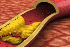 高血脂有哪些危害？怎樣降低血脂？[圖]