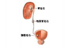 膀胱結石手術治療會有效嗎？膀胱結石手術治療的效果[圖]