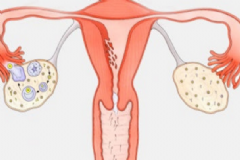 卵巢切除后怎么保養(yǎng)好？卵巢切除后怎么保養(yǎng)？[圖]