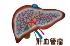 肝血管瘤嚴重嗎？肝血管瘤的癥狀表現(xiàn)[圖]