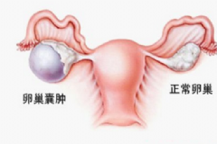 卵巢腫瘤嚴重嗎？卵巢腫瘤手術(shù)[圖]