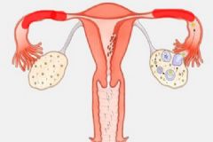 輸卵管堵塞還能排卵嗎？輸卵管堵塞怎么辦？[多圖]