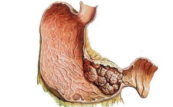 胃癌早期能治好嗎？胃癌早期有那些癥狀？(1)
