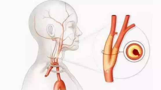 血管狹窄是什么意思？血管狹窄可以恢復(fù)嗎？