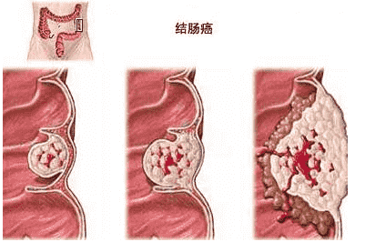 最新！武漢江漢博仕醫(yī)院：腸道篩查做什么檢查