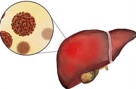 肝病怎么徹底治好？如何預(yù)防肝病