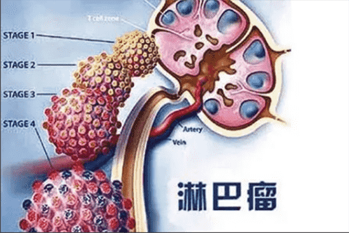 濟(jì)南血液病醫(yī)院科普：治療非霍奇金淋巴瘤，化療、移植哪個(gè)好？