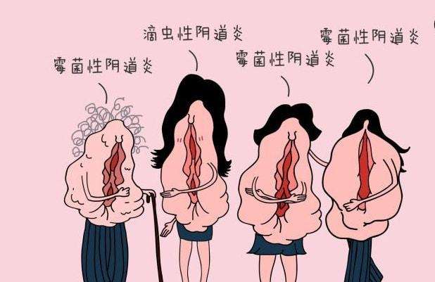 女性在生活中怎樣預(yù)防女性私處炎癥？女性私處炎反復(fù)發(fā)作原因[圖]