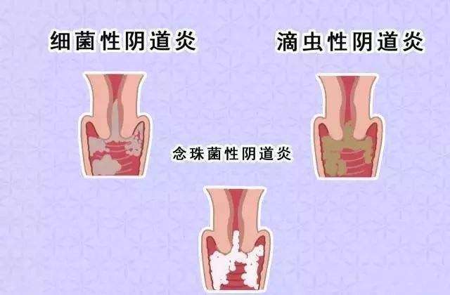 霉菌性陰道炎的表現(xiàn)有哪些？日常需要怎樣護(hù)理？[圖]