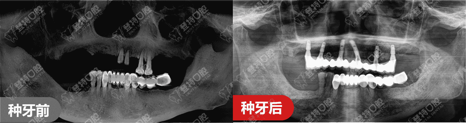 顛覆傳統(tǒng)種牙，佛山登特口腔一日得技術(shù)，一天搞定種牙全過(guò)程