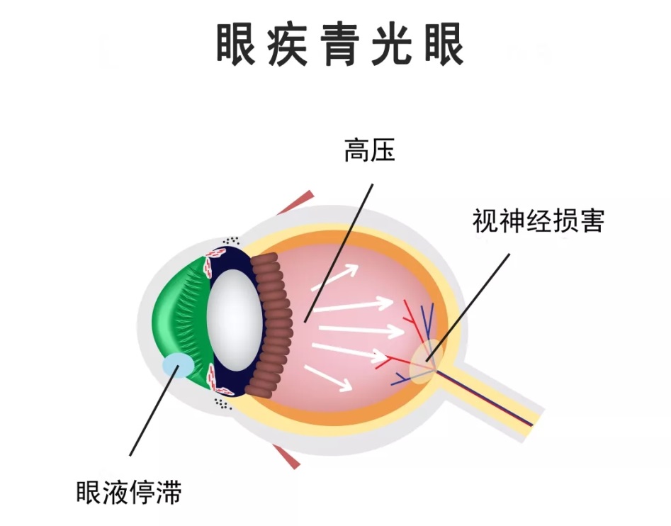 合肥愛爾眼科：青光眼預(yù)防一定要“早”