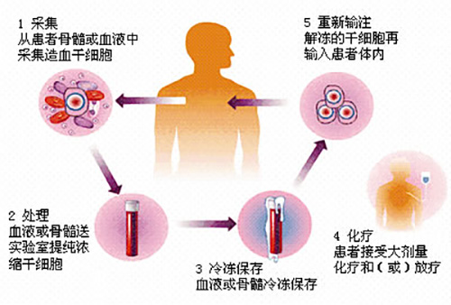 濟(jì)南血液病醫(yī)院科普：什么是自體移植？淋巴瘤患者有必要做嗎？