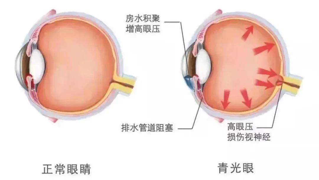 【合肥愛(ài)爾眼科】提醒：任何年齡都可能患上青光眼