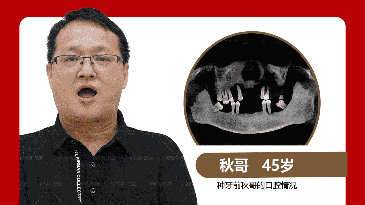 佛山登特口腔：全口半口缺牙修復方式怎么選？