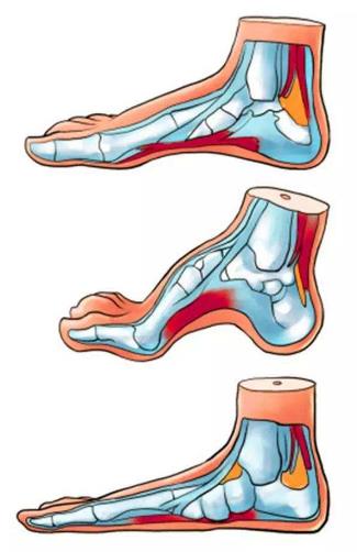 扁平足能跑步嗎？扁平足跑步有什么危害？