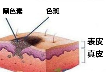 祛斑霜用出終生難愈皮炎，千金散去再也換不回一張健康臉！