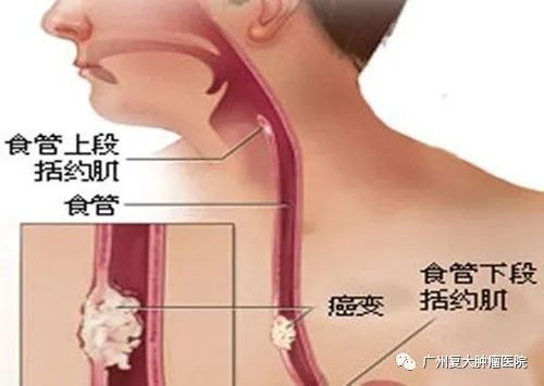 上海腫瘤醫(yī)院請選擇廣州復(fù)大腫瘤醫(yī)院：食管癌轉(zhuǎn)移還能治嗎